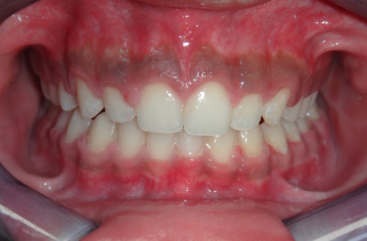 Smile before metal braces for an overbite