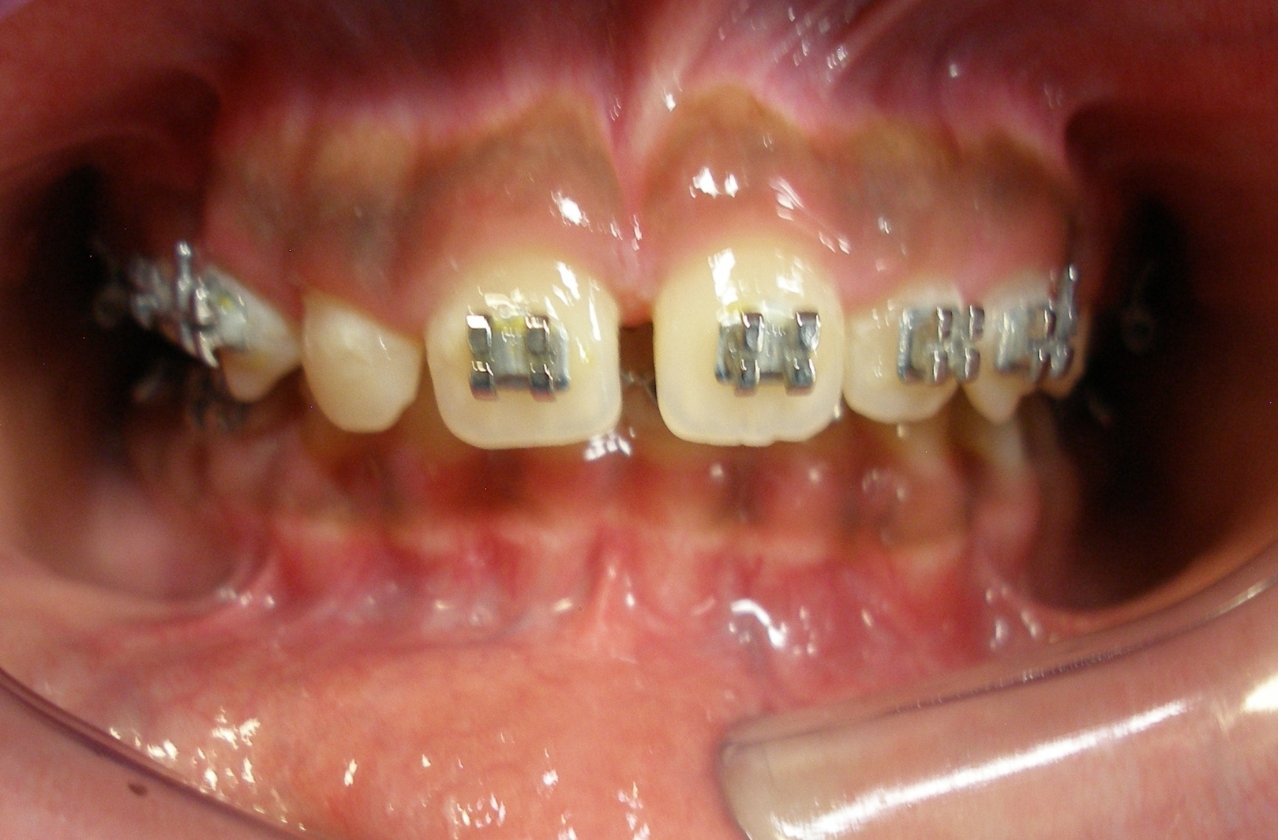 Smile after metal braces for an overbite