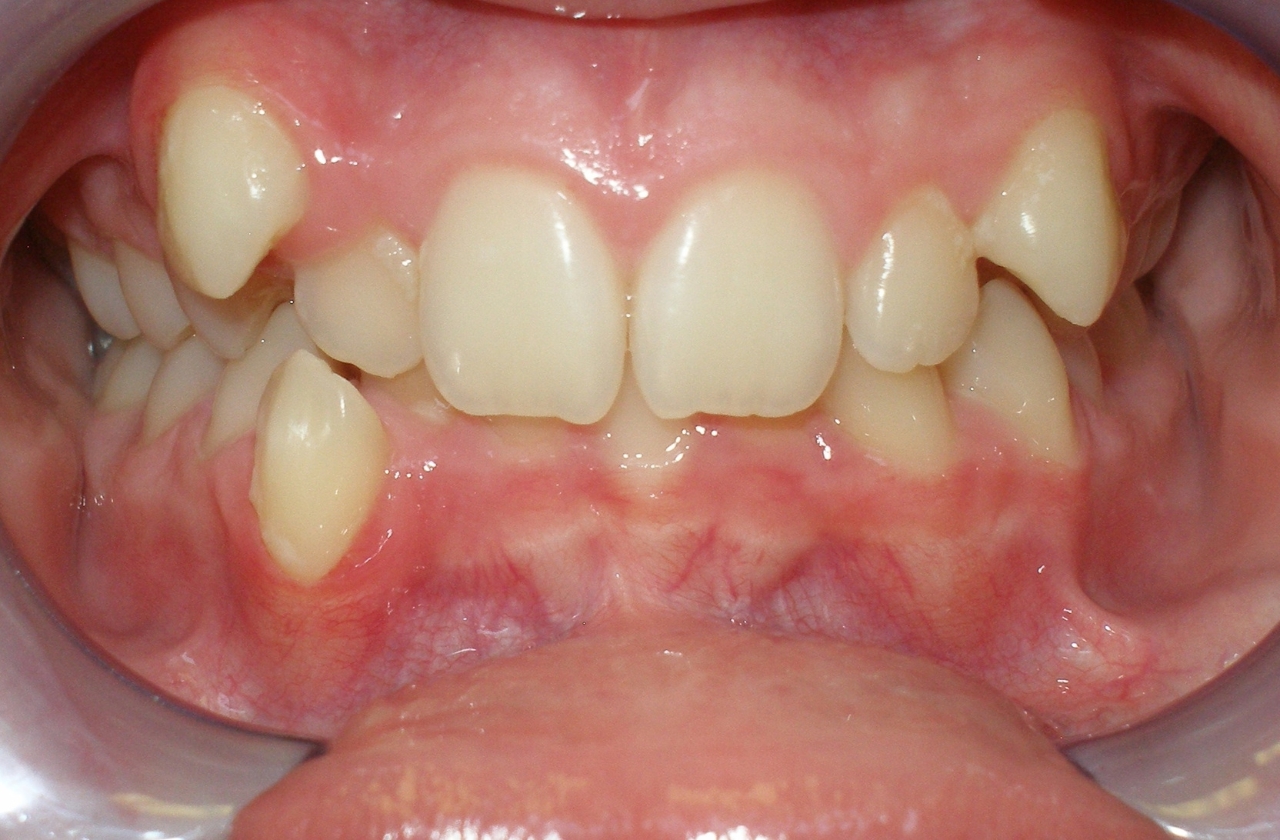 Smile after orthodontic treatment for severe crowding
