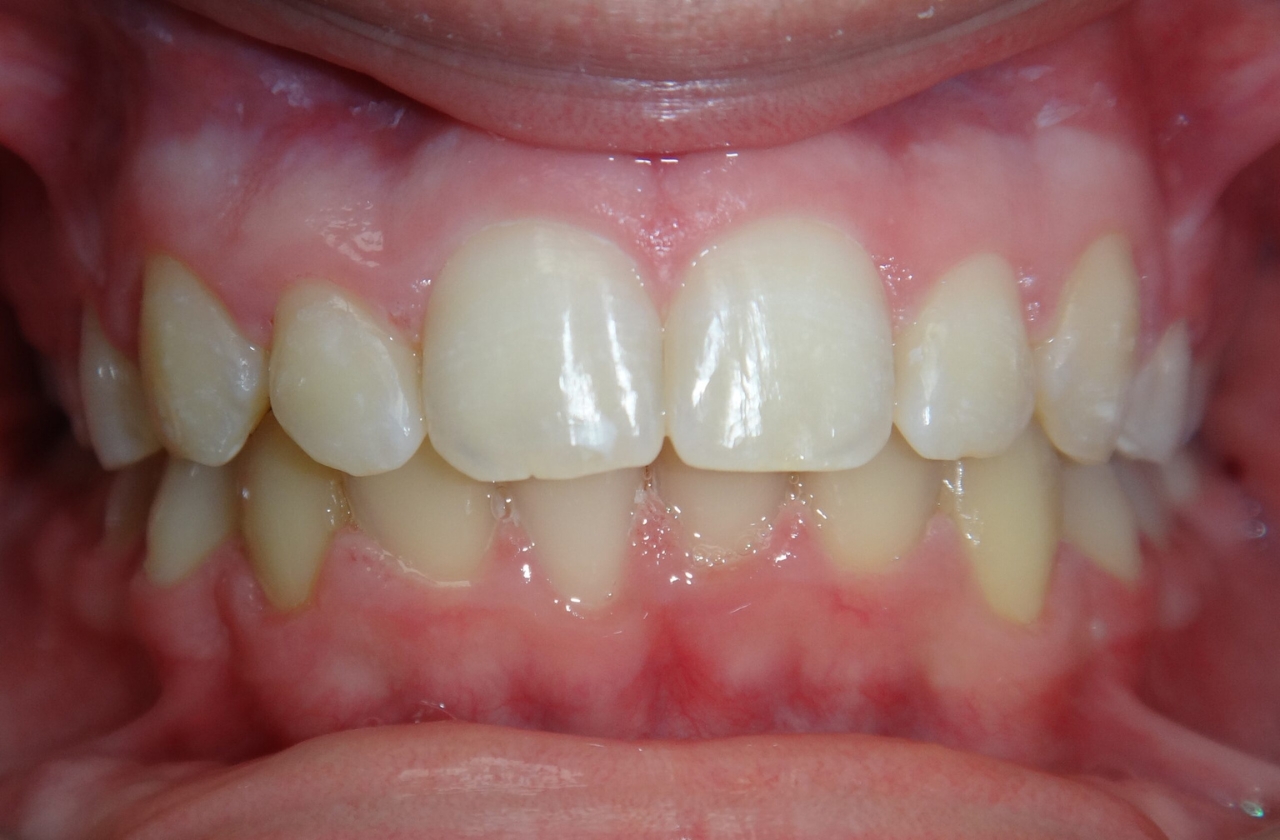 Smile before orthodontic treatment for severe crowding