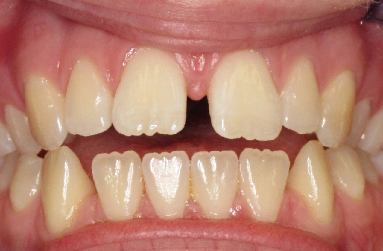 Smile after Invisalign treatment for an open bite