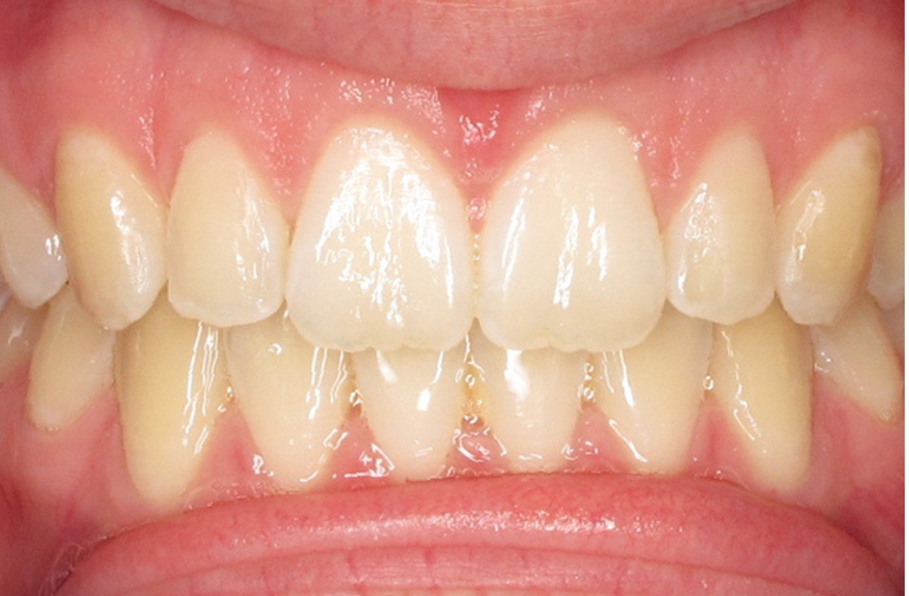 Smile before Invisalign treatment for an open bite